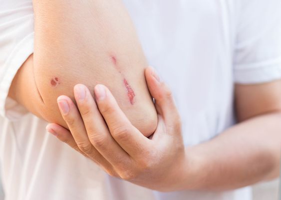 Why do scars often appear red?