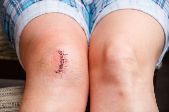 Why are scars on the knees more likely to proliferate?