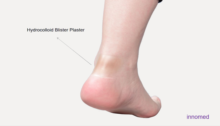 Nursing effect of Hydrocolloid Blister Plaster on heel friction injury