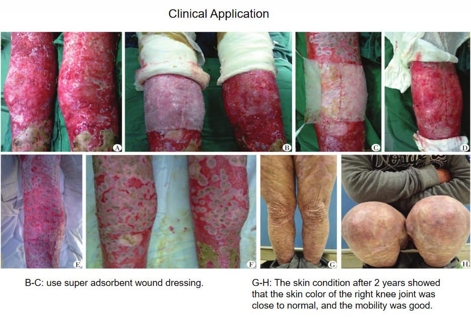 superadsorbent wound dressing 2