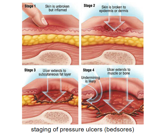 Bedsores (pressure ulcers): Treatments, stages, causes, and pictures