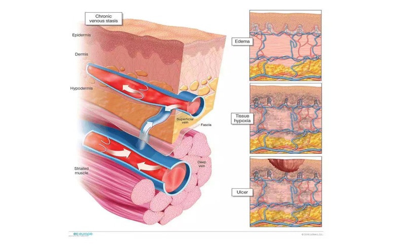 leg venou sulcer