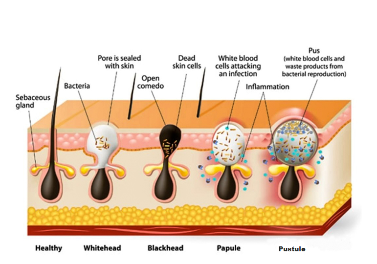 acne classification