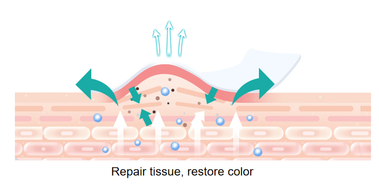 Longterm medical silicone scar dressing tubular : Attention pregnant women! Teach you to prevent stretch marks 