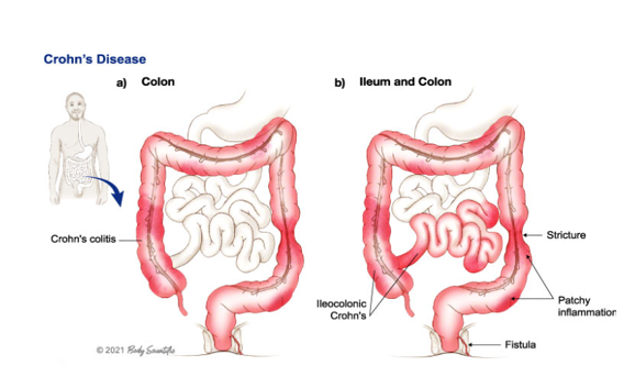stoma