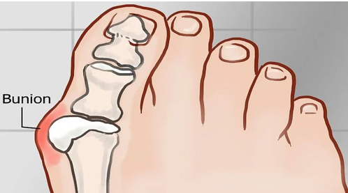 bunions