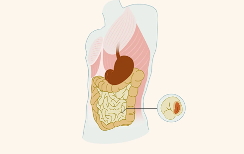 ostomy 