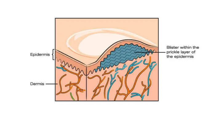 blister