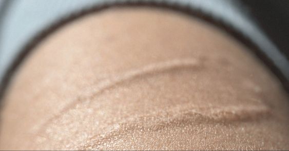 silicone scar dressing
