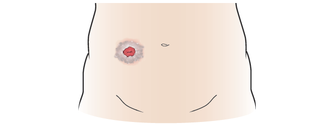 Stoma infection