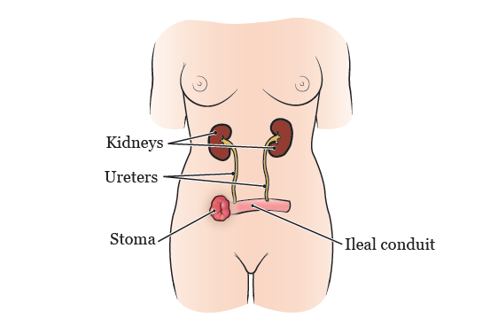 Stoma