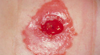 wound
