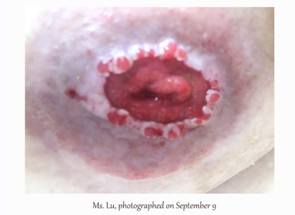 Stoma