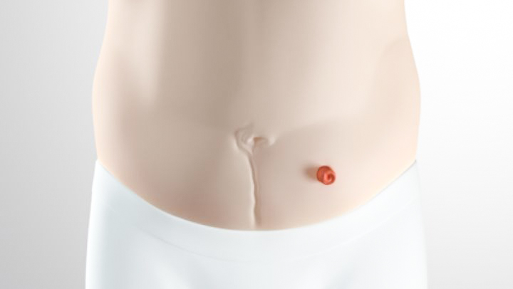 Stoma