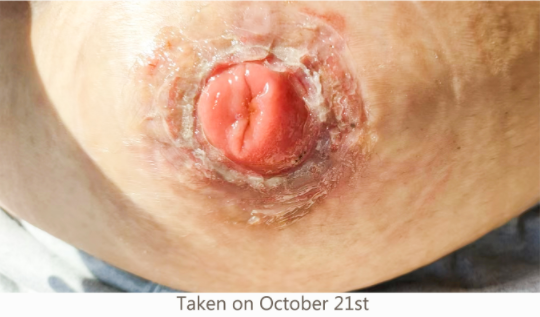 Stoma
