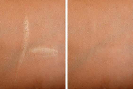 How To Restore White Scars 