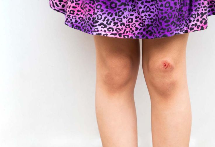 Is wound ventilation more important than sealing?