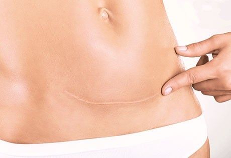 Why do scars become wider after surgery?