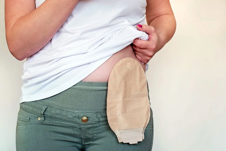 Is the odor of the stoma bag bothering you?