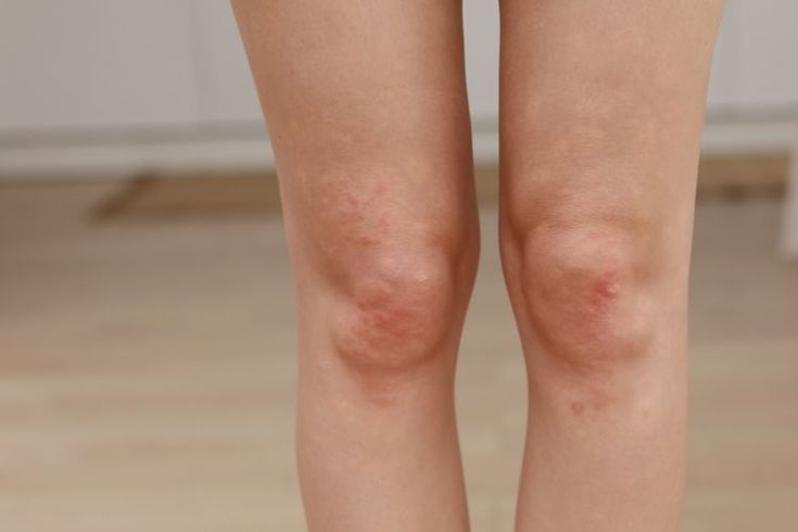 Why do blisters appear on newly healed skin?