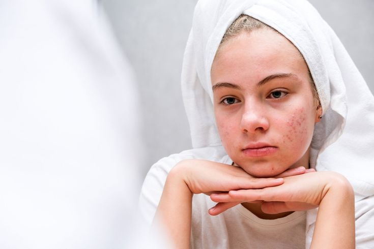 The small red bumps are extremely itchy, but many people mistake them for acne