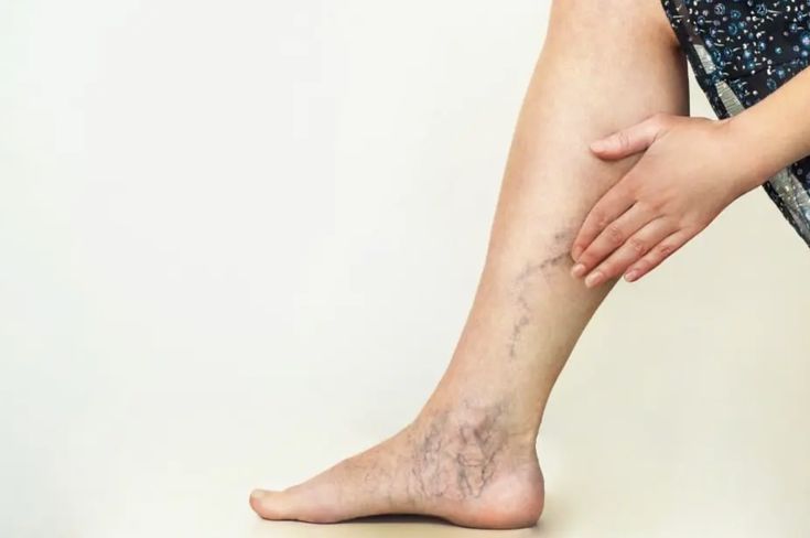 Chronic venous insufficiency wounds of lower extremities