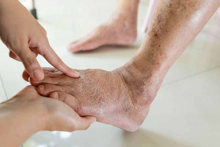 Tips for diabetics to wear shoes correctly