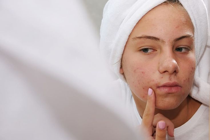  Home Care Tips for Acne