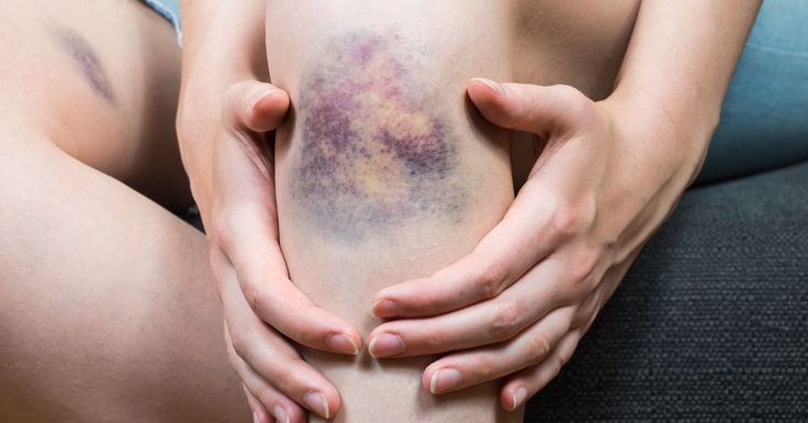 Common problems with skin hematoma and how to treat them?