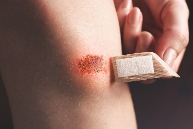 Treatment of minor wounds in summer