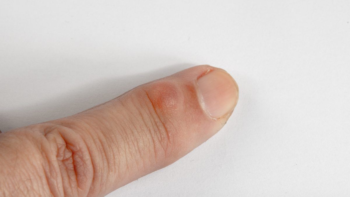 What happens if a lump appears after a finger wound heals?