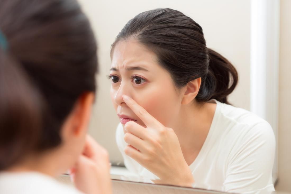 if whiteheads appear in acne?