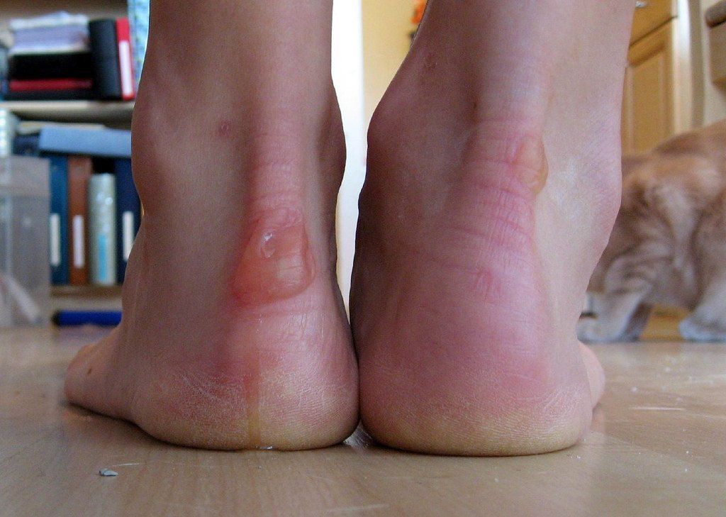 How to treat boot heel blisters？