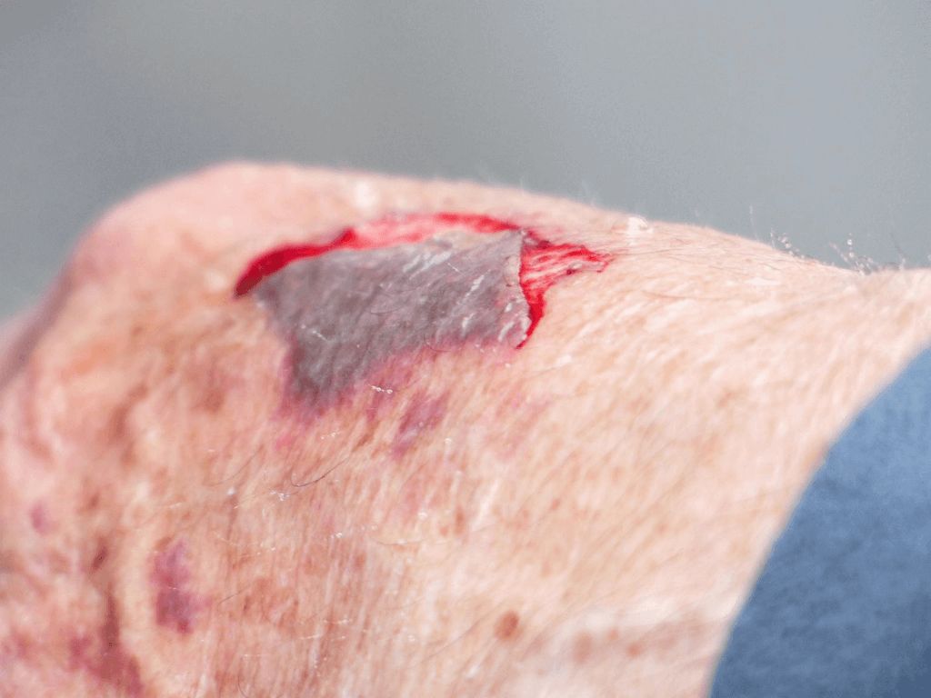 What is a skin avulsion injury?