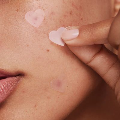 What should I do if a pimple pops ?