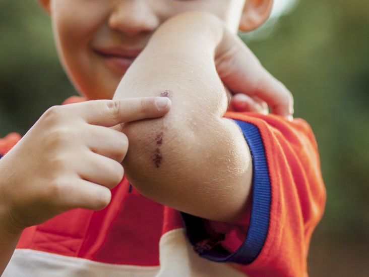 Should you peel off the scab when a wound is healing?