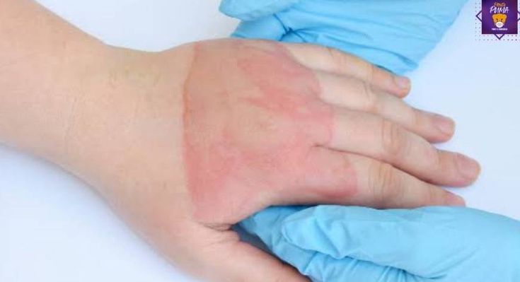  5 common emergency first aid treatments