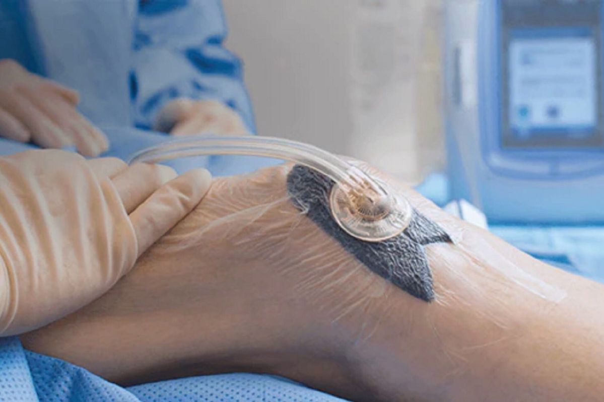 Will negative pressure therapy irritate or cause pain to the wound?