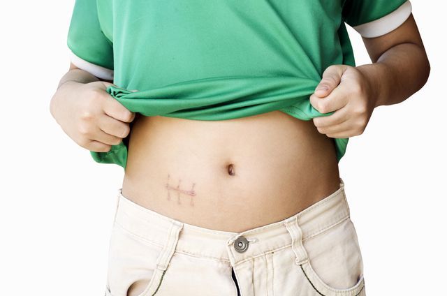 How many days should the incision dressing be applied after appendicitis surgery?
