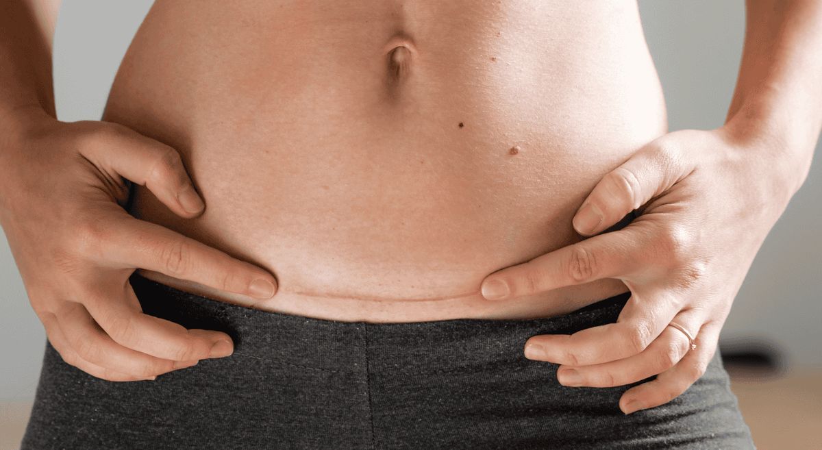 Prevention of surgical site infection during cesarean section