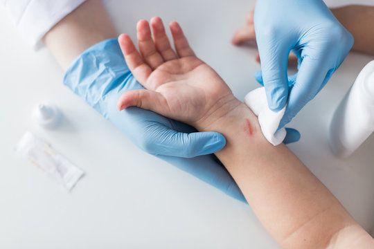 Why is wound rinsing important?