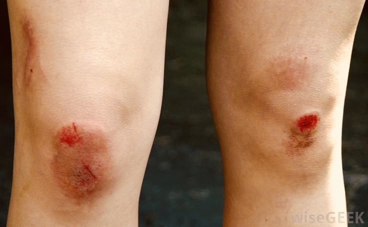 Will using multiple layers of dressings cause oxygen deprivation in the wound?