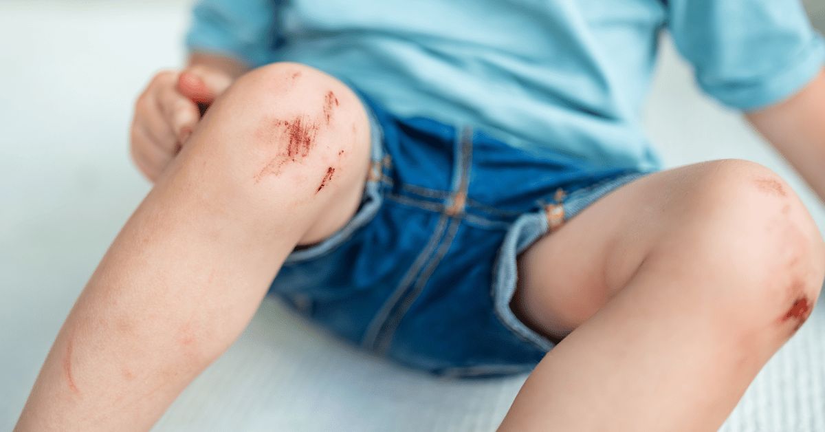 Childhood Injury Management: When Stitches Are Necessary, and When Can Home Care Be Provided?