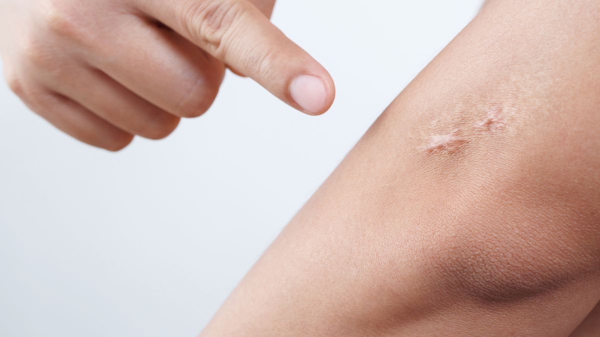 When should hypertrophic scars be intervened? Is there any hope if the golden period is missed ?